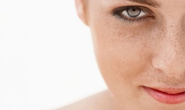 Пигментные пятна, веснушки, мелазма, постакне: причины и лечение