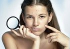 Уход за подростковой кожей: как избавиться от прыщей