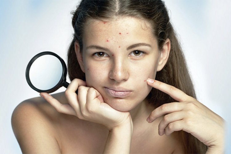 Уход за подростковой кожей: как избавиться от прыщей